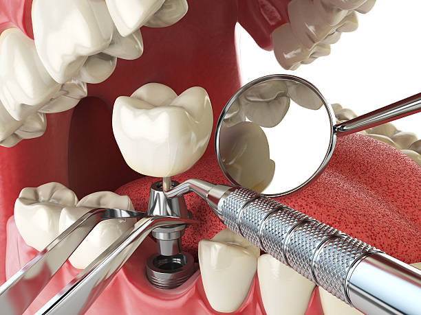Best Emergency Tooth Extraction in Ontonagon, MI